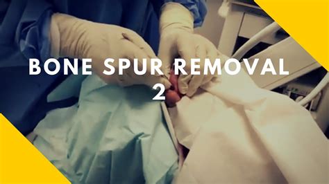 Dental bone spurs (also known as bone spicules) are small bone pieces that become dislodged from the surrounding tissue but are still trapped in your gums. . Dental bone spur removal cost